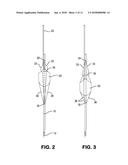 Inflatable Transcatheter Intracardiac Devices And Methods For Treating     Incompetent Atrioventricular Valves diagram and image