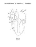 Inflatable Transcatheter Intracardiac Devices And Methods For Treating     Incompetent Atrioventricular Valves diagram and image