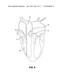 Inflatable Transcatheter Intracardiac Devices And Methods For Treating     Incompetent Atrioventricular Valves diagram and image