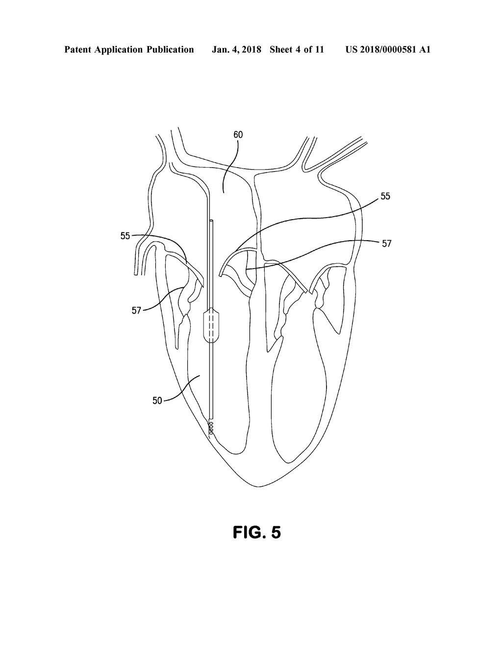 Inflatable Transcatheter Intracardiac Devices And Methods For Treating     Incompetent Atrioventricular Valves - diagram, schematic, and image 05