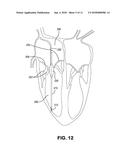 Inflatable Transcatheter Intracardiac Devices And Methods For Treating     Incompetent Atrioventricular Valves diagram and image