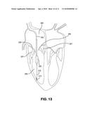 Inflatable Transcatheter Intracardiac Devices And Methods For Treating     Incompetent Atrioventricular Valves diagram and image