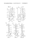 System and Method for Fracture Replacement of Comminuted Bone Fractures or     Portions Thereof Adjacent Bone Joints diagram and image