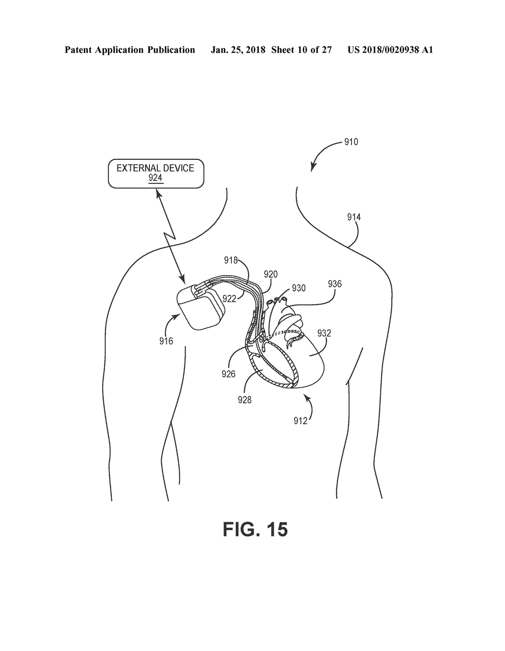 IDENTIFYING AMBIGUOUS CARDIAC SIGNALS FOR ELECTROPHYSIOLOGIC MAPPING - diagram, schematic, and image 11