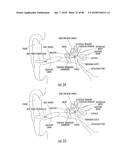 INFLATABLE EAR DEVICE diagram and image
