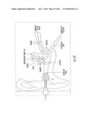 INFLATABLE EAR DEVICE diagram and image