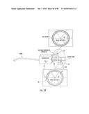 INFLATABLE EAR DEVICE diagram and image