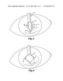Expansion Ring For Eyeball Tissue diagram and image
