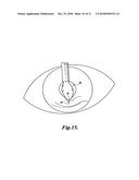 Expansion Ring For Eyeball Tissue diagram and image